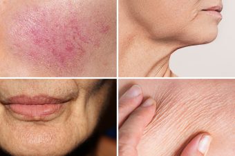 Skin Issues for each Type